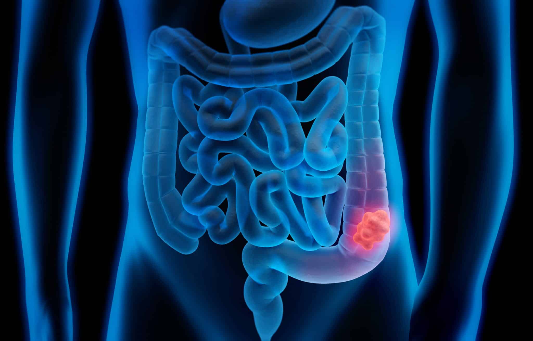 A medical illustration showing the appearance of colorectal cancer and the importance of screening early.